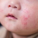Read more about the article Dealing with Baby Skin Rashes