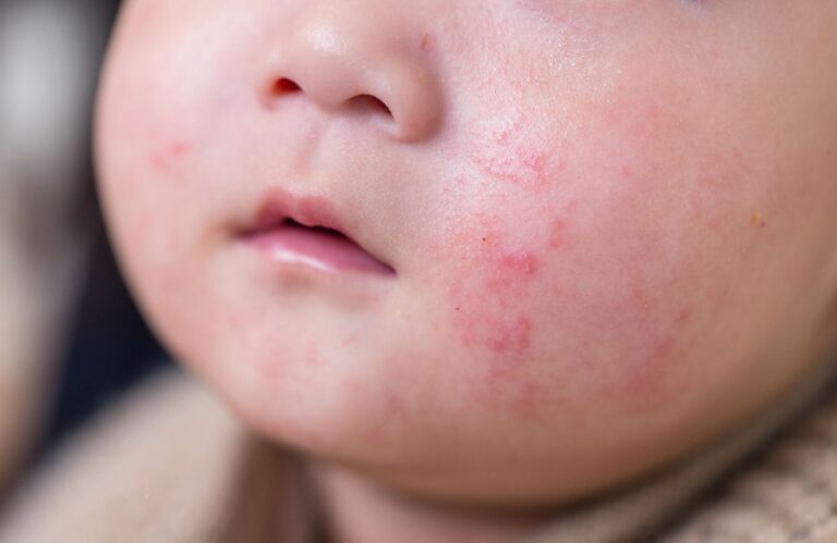 Read more about the article Dealing with Baby Skin Rashes